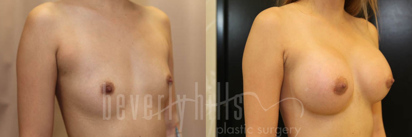 Breast Augmentation 19 Before & After