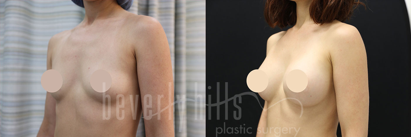 Breast Augmentation 71 Before & After