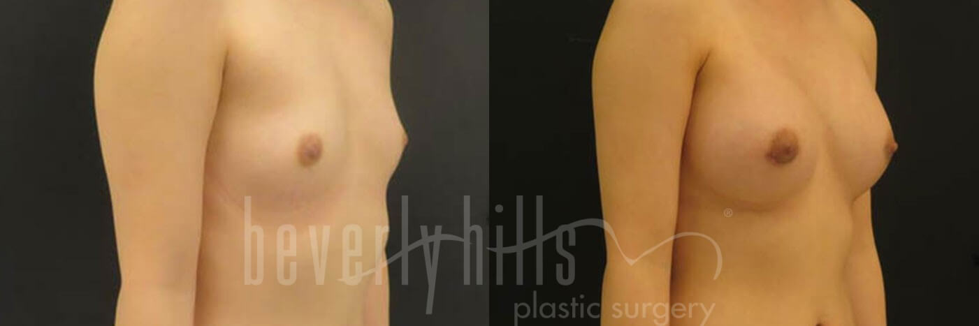 Breast Augmentation 22 Before & After