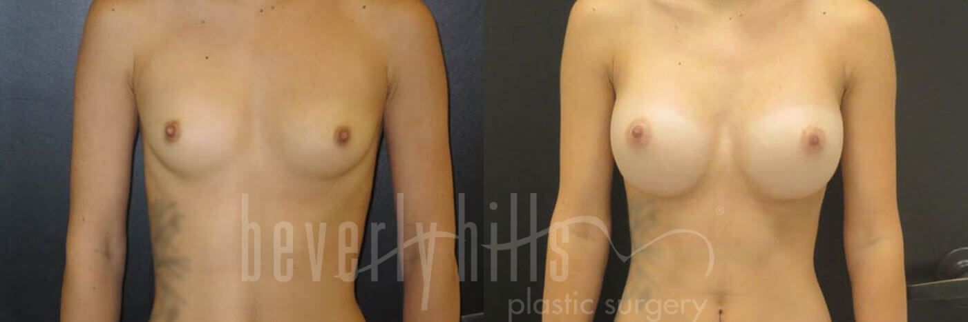 Breast Augmentation 23 Before & After