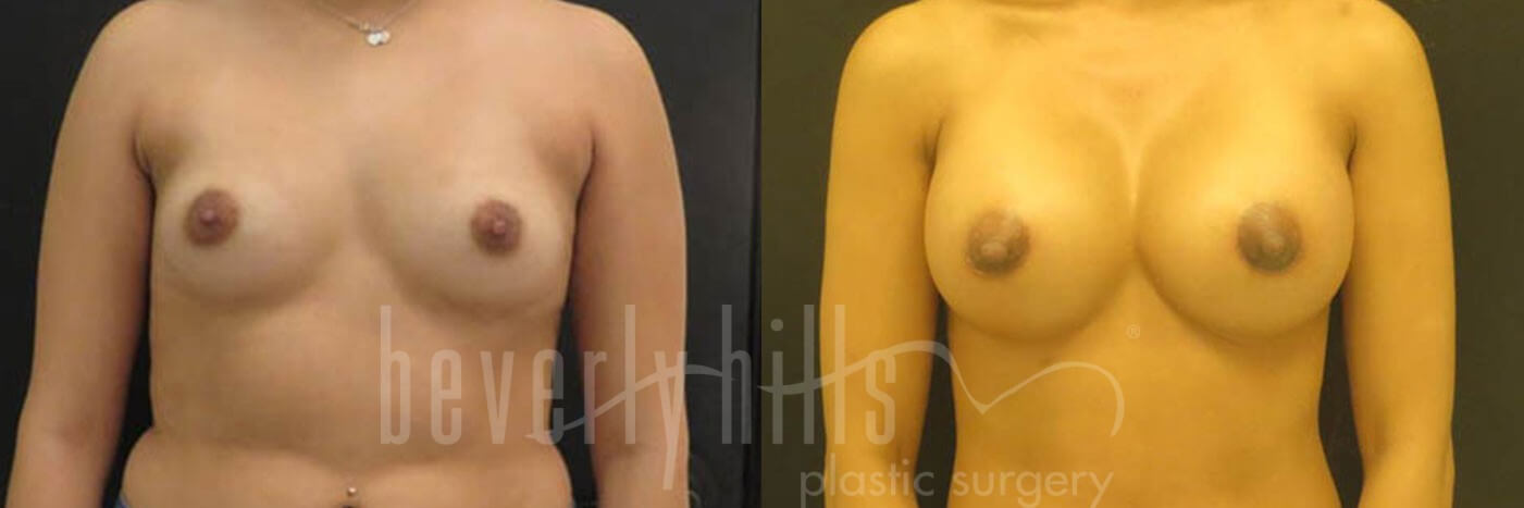 Breast Augmentation 24 Before & After