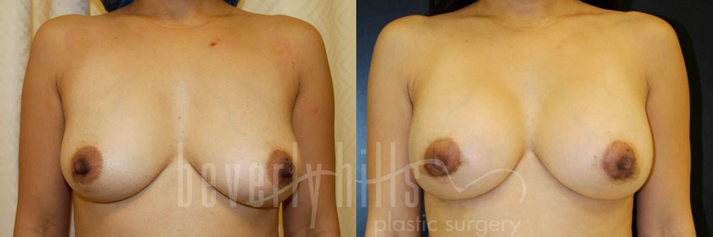 Breast Augmentation 26 Before & After