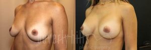Breast Augmentation 27 Before & After - Thumbnail