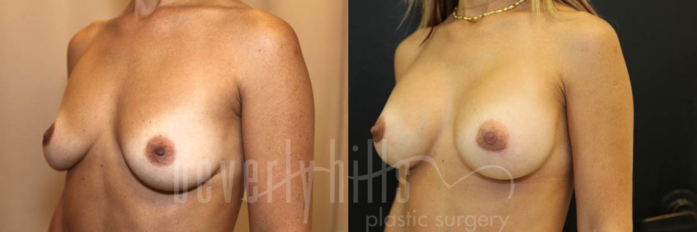 Breast Augmentation 27 Before & After