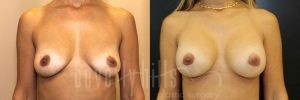 Breast Augmentation 27 Before & After - Thumbnail