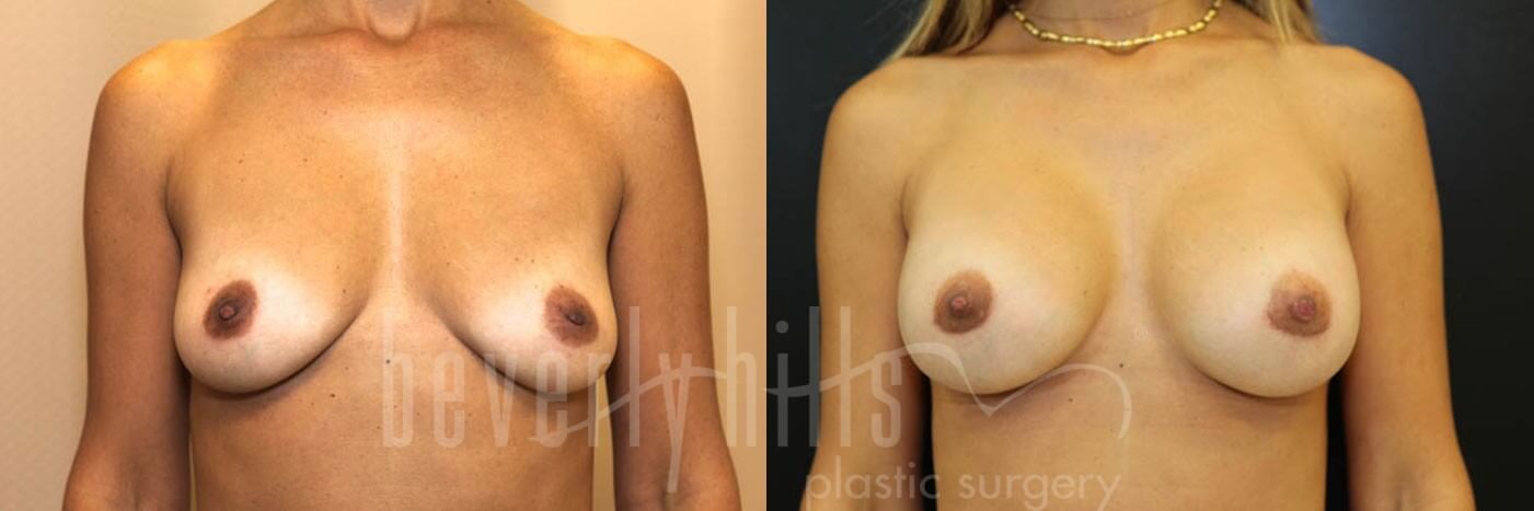 Breast Augmentation 27 Before & After