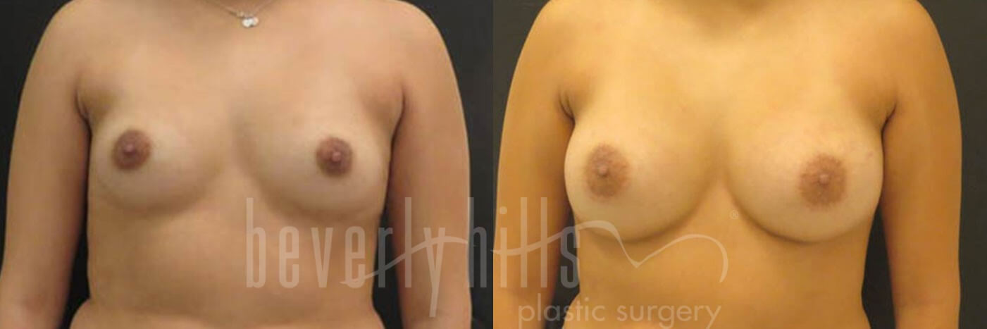 Breast Augmentation 28 Before & After
