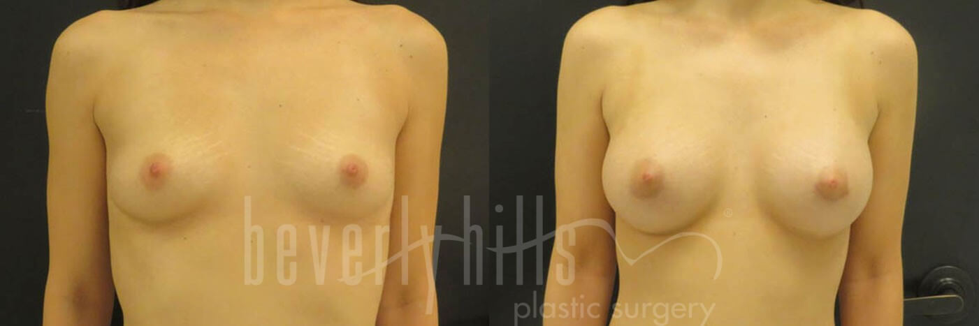 Breast Augmentation 31 Before & After