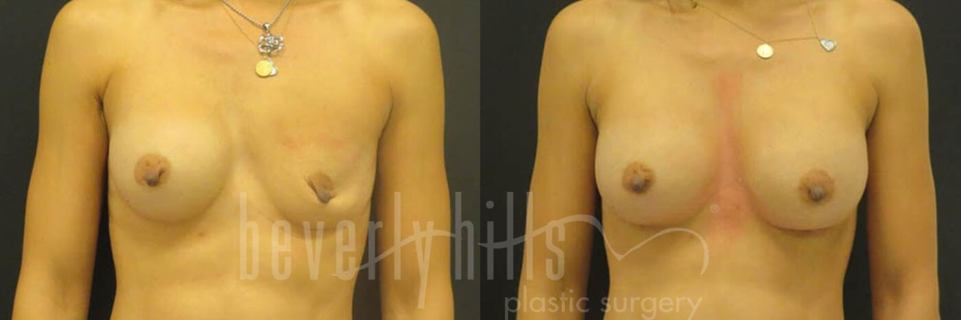 Breast Augmentation 32 Before & After