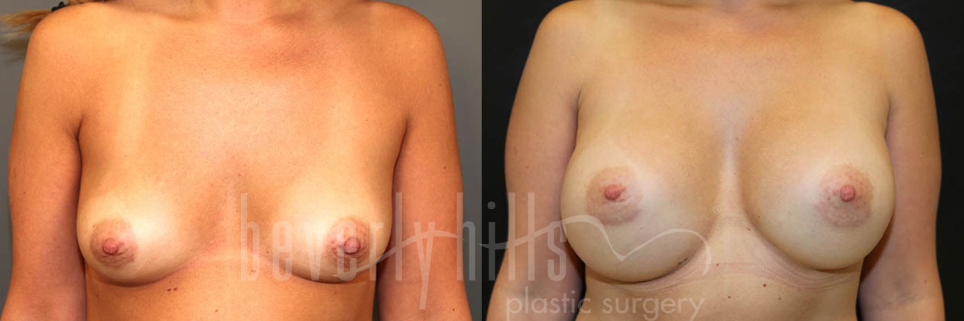 Breast Augmentation 33 Before & After