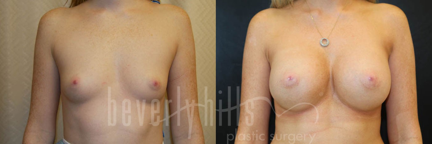 Breast Augmentation 34 Before & After