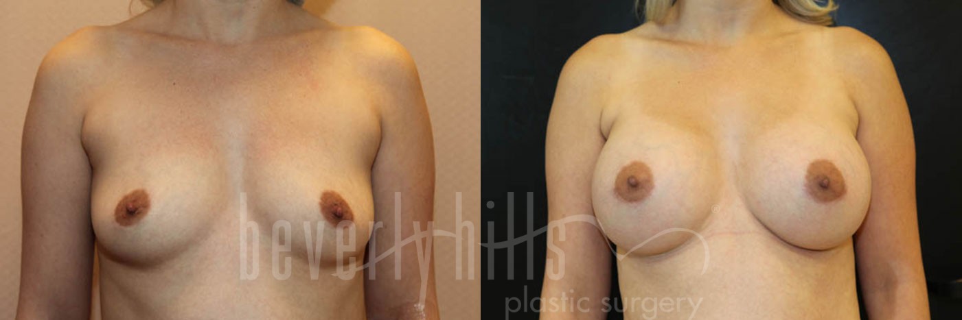 Breast Augmentation 36 Before & After