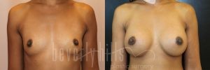 Breast Augmentation 37 Before & After - Thumbnail
