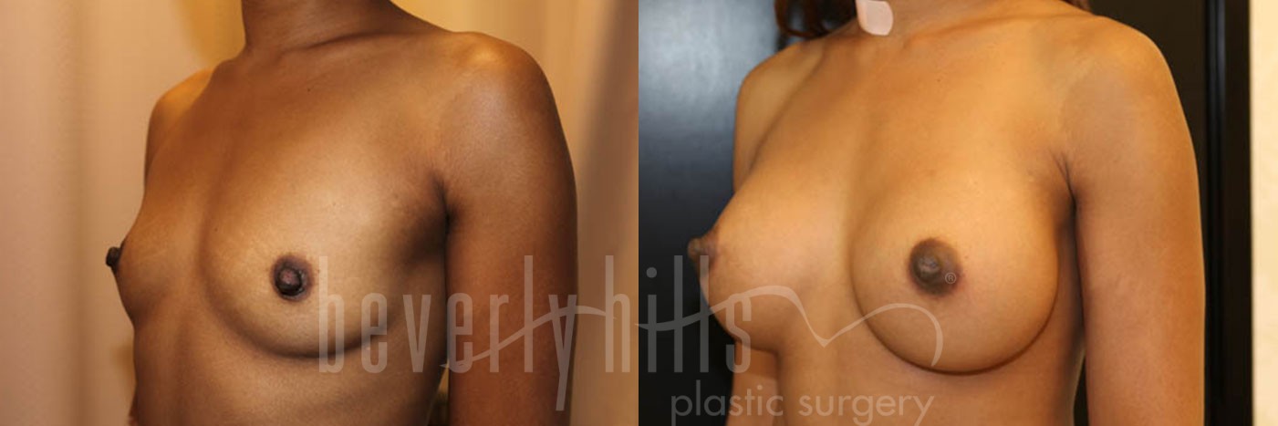 Breast Augmentation 37 Before & After