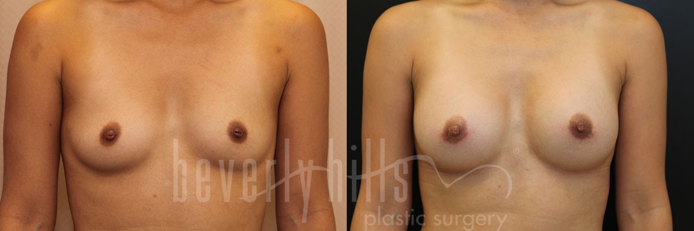 Breast Augmentation 40 Before & After