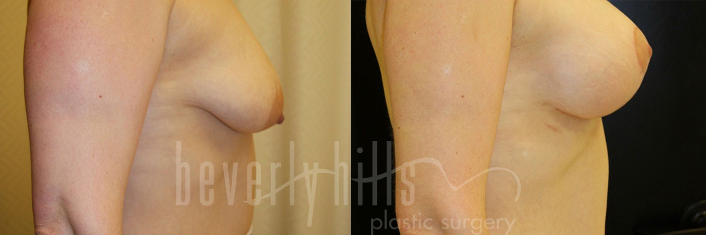 Breast Augmentation 41 Before & After