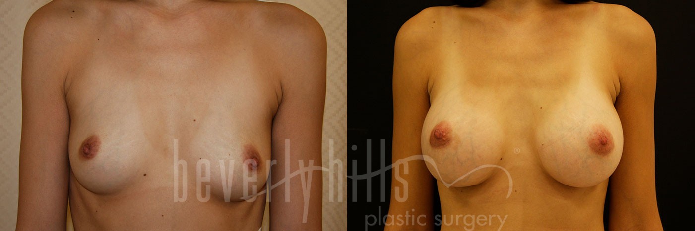 Breast Augmentation 42 Before & After