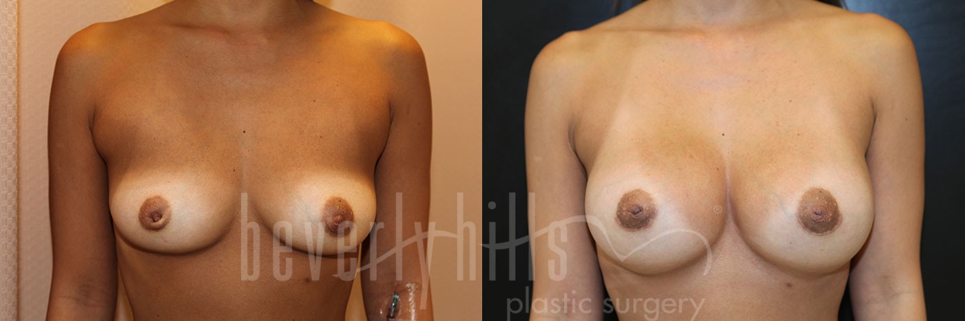 Breast Augmentation 43 Before & After