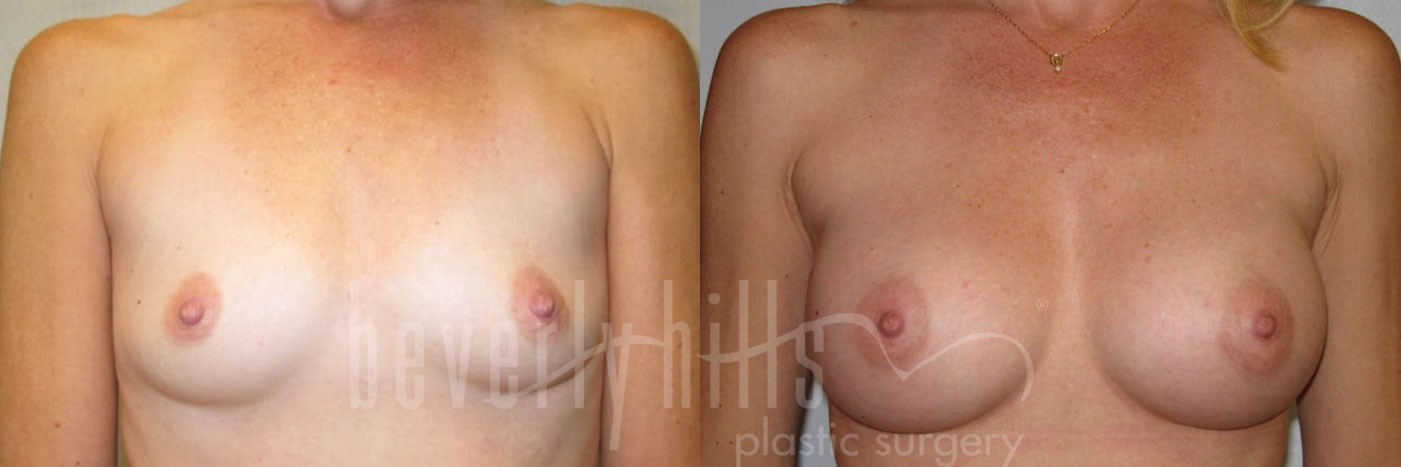 Breast Augmentation 44 Before & After
