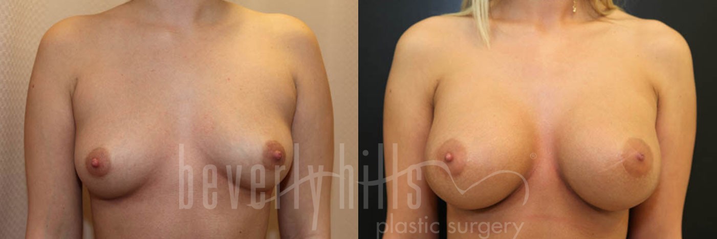 Breast Augmentation 45 Before & After
