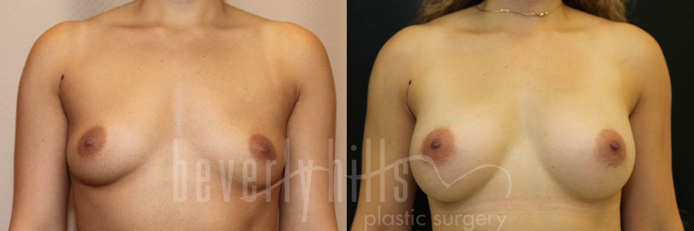 Breast Augmentation 46 Before & After