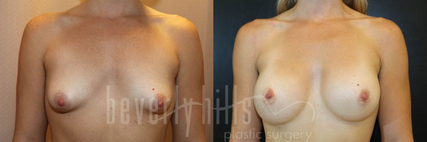 Breast Augmentation 47 Before & After