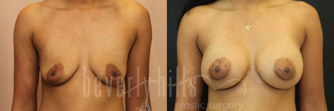 Breast Augmentation 48 Before & After