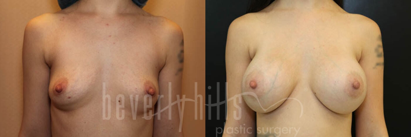 Breast Augmentation 49 Before & After
