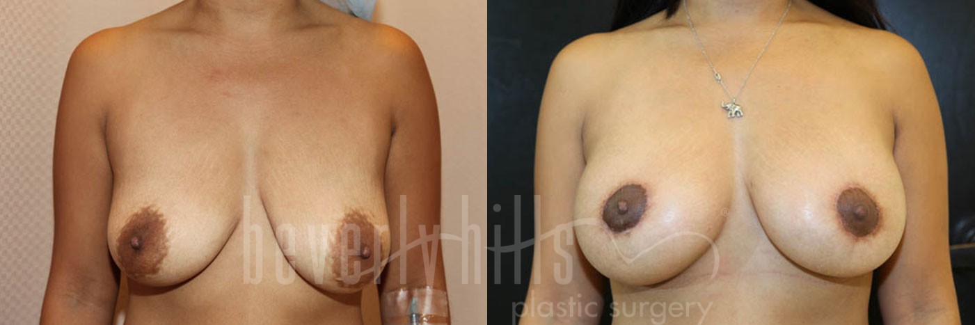 Breast Augmentation 51 Before & After