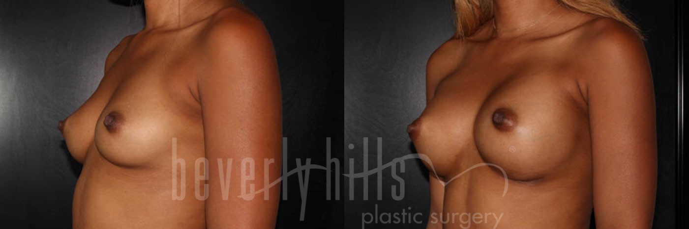Breast Augmentation 52 Before & After