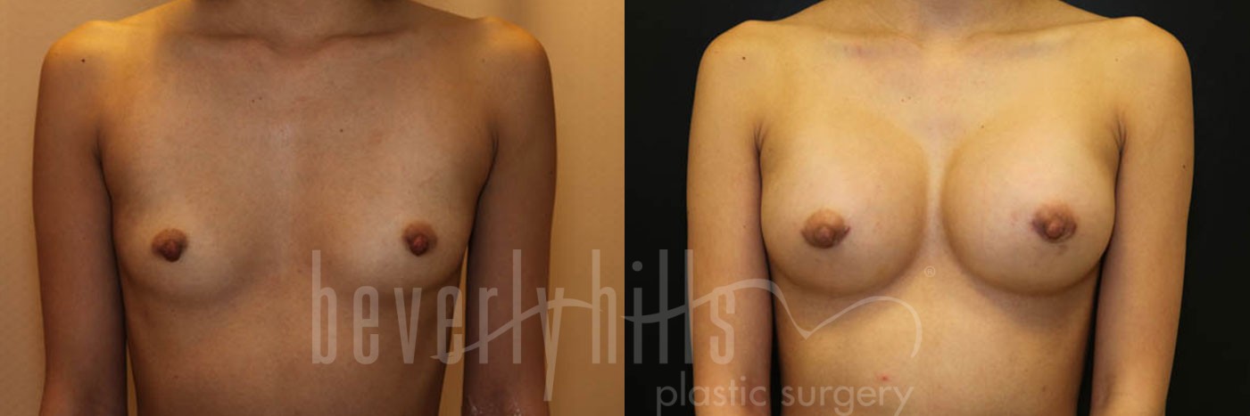Breast Augmentation 53 Before & After