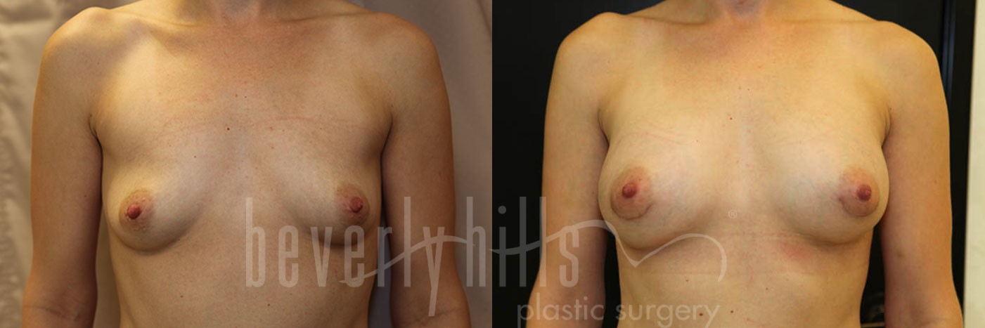 Breast Augmentation 55 Before & After