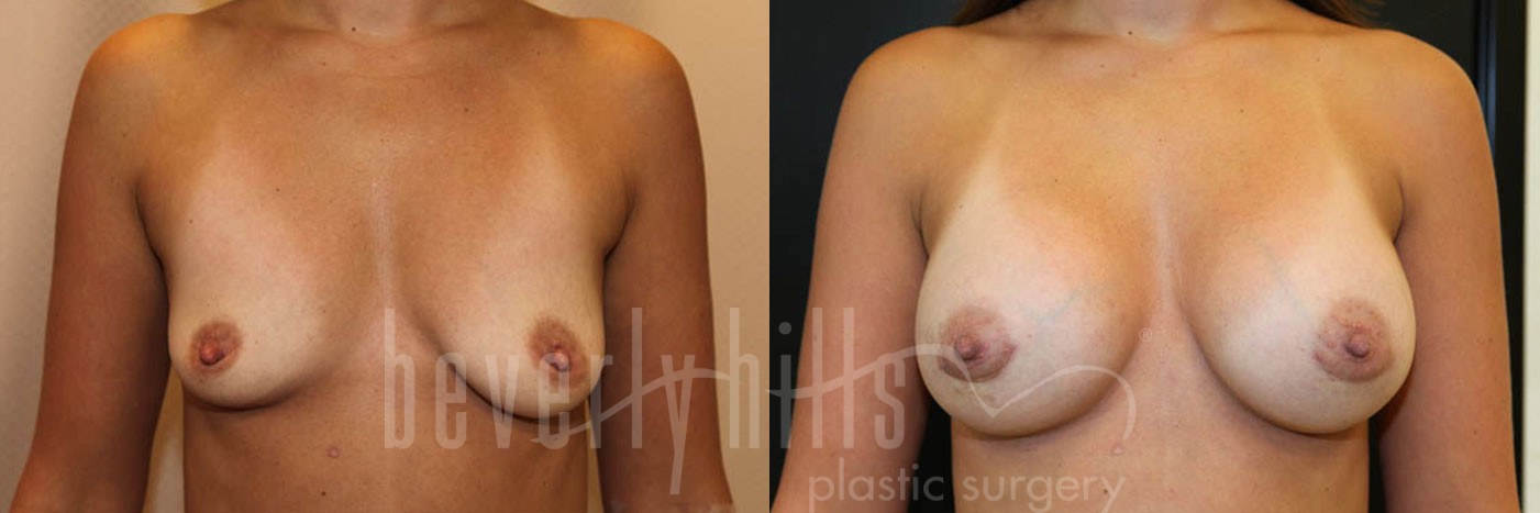 Breast Augmentation 56 Before & After