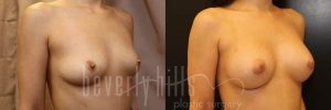 Breast Augmentation 57 Before & After - Thumbnail