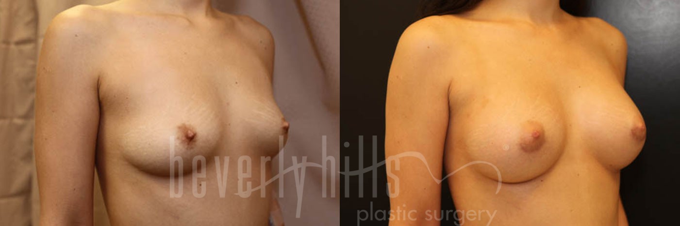 Breast Augmentation 57 Before & After