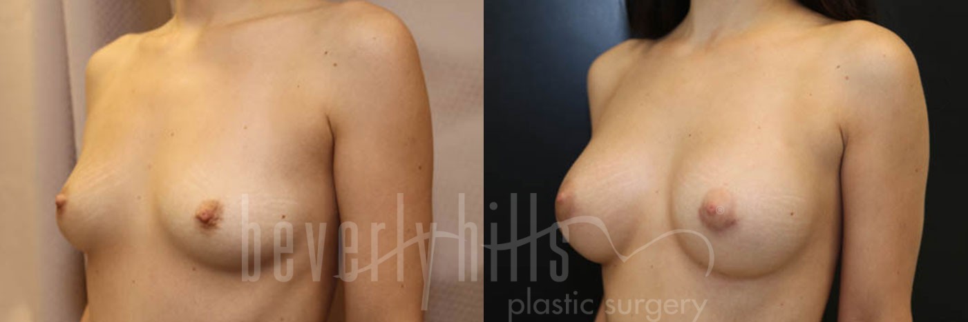 Breast Augmentation 57 Before & After
