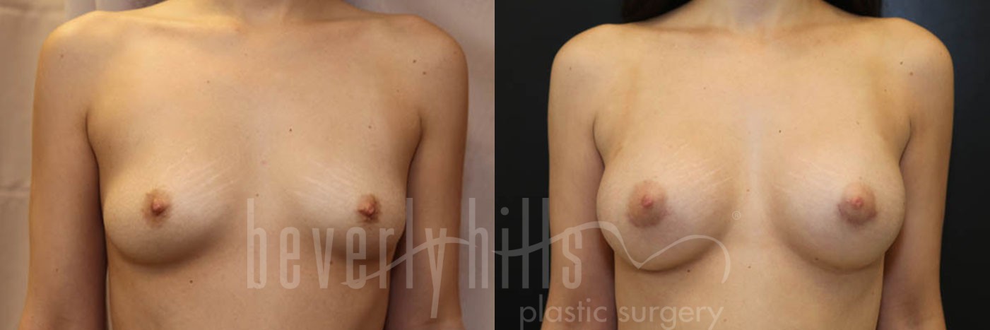 Breast Augmentation 57 Before & After