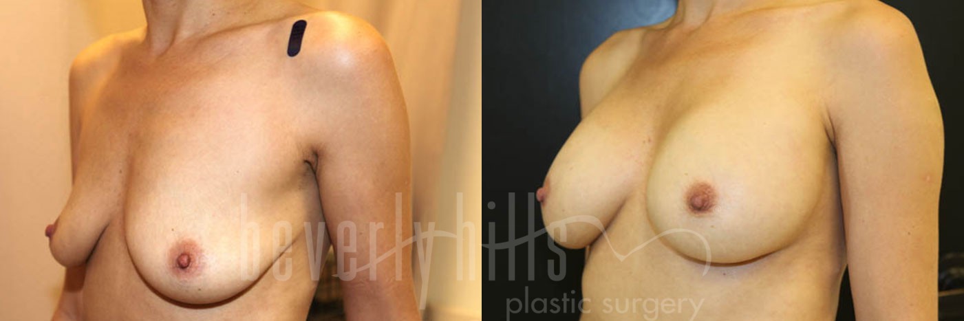 Breast Augmentation 58 Before & After