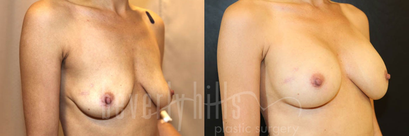 Breast Augmentation 58 Before & After