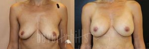 Breast Augmentation 58 Before & After - Thumbnail