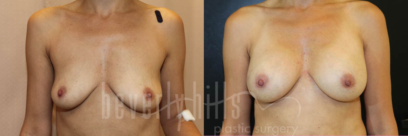 Breast Augmentation 58 Before & After