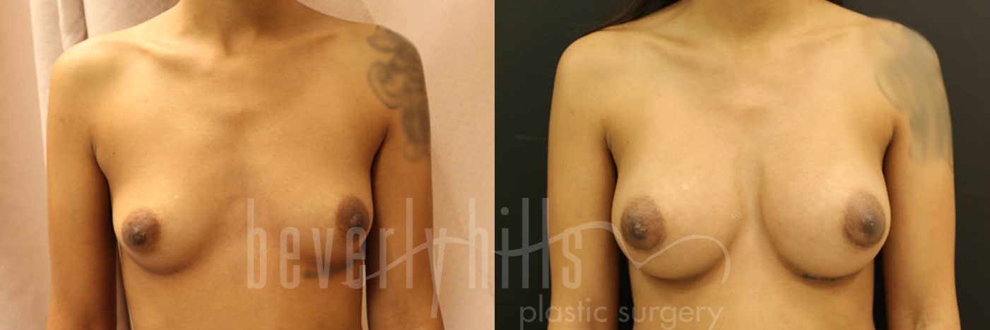 Breast Augmentation 60 Before & After