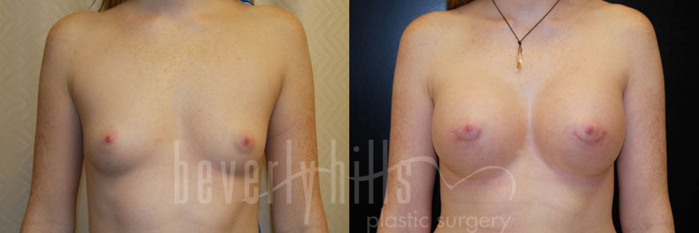 Breast Augmentation 61 Before & After