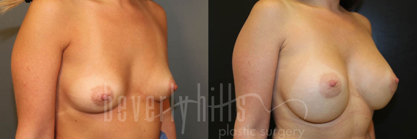 Breast Augmentation 62 Before & After