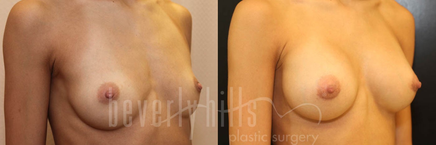 Breast Augmentation 65 Before & After