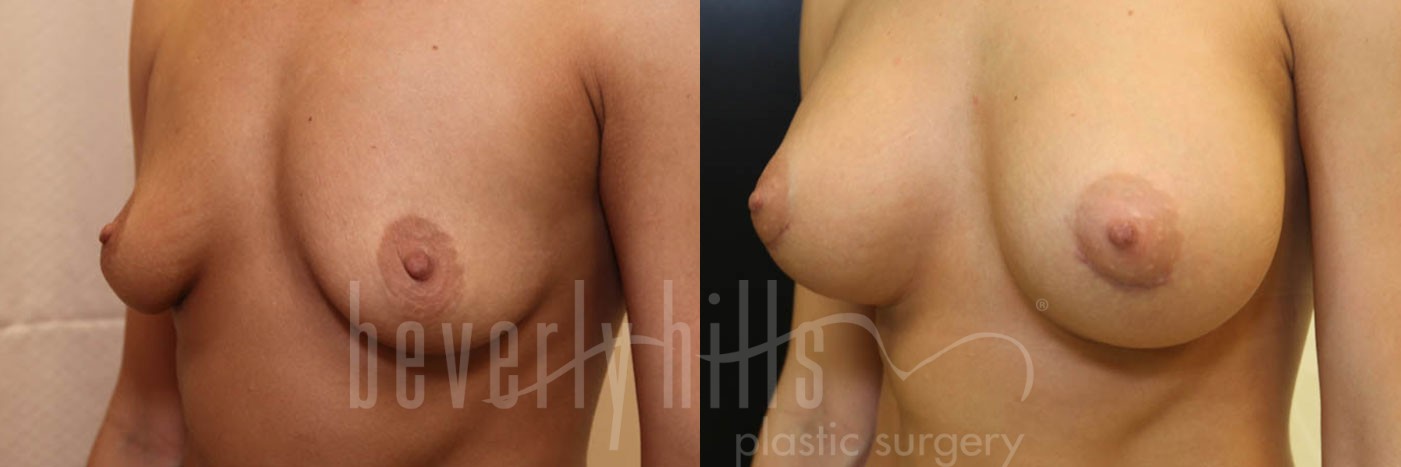 Breast Augmentation 67 Before & After