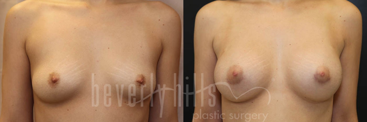 Breast Augmentation 68 Before & After