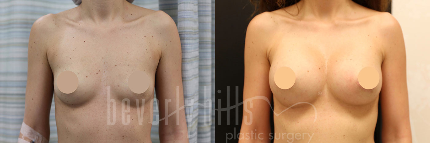 Breast Augmentation 69 Before & After