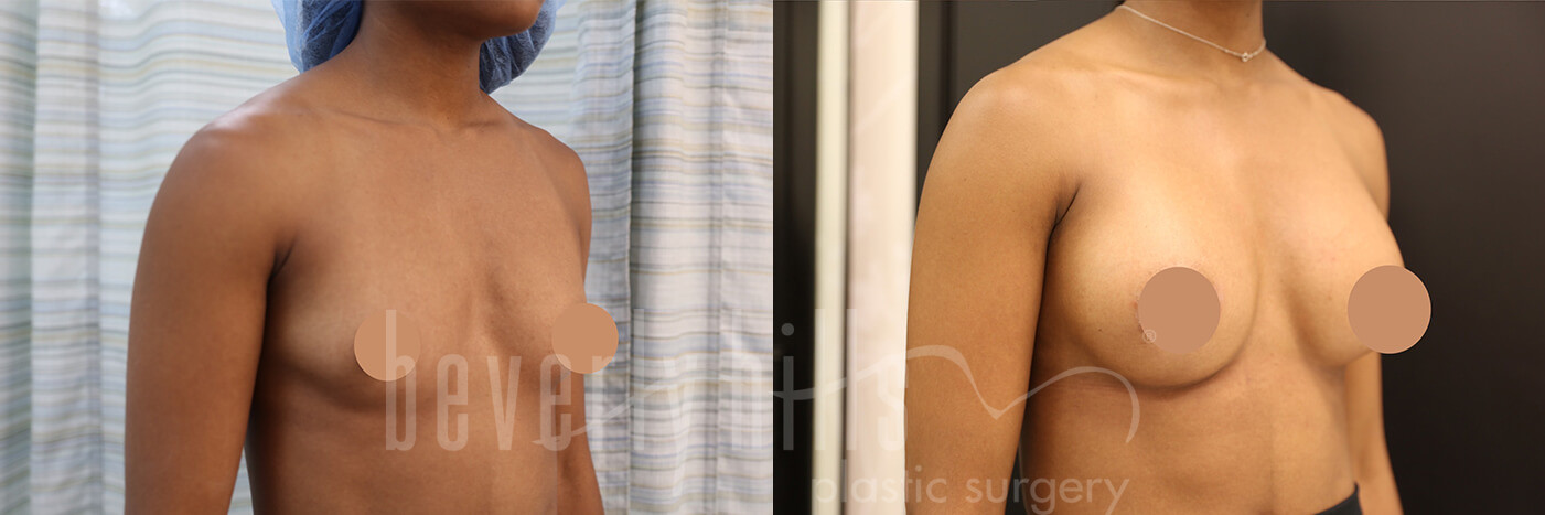 Breast Augmentation 70 Before & After
