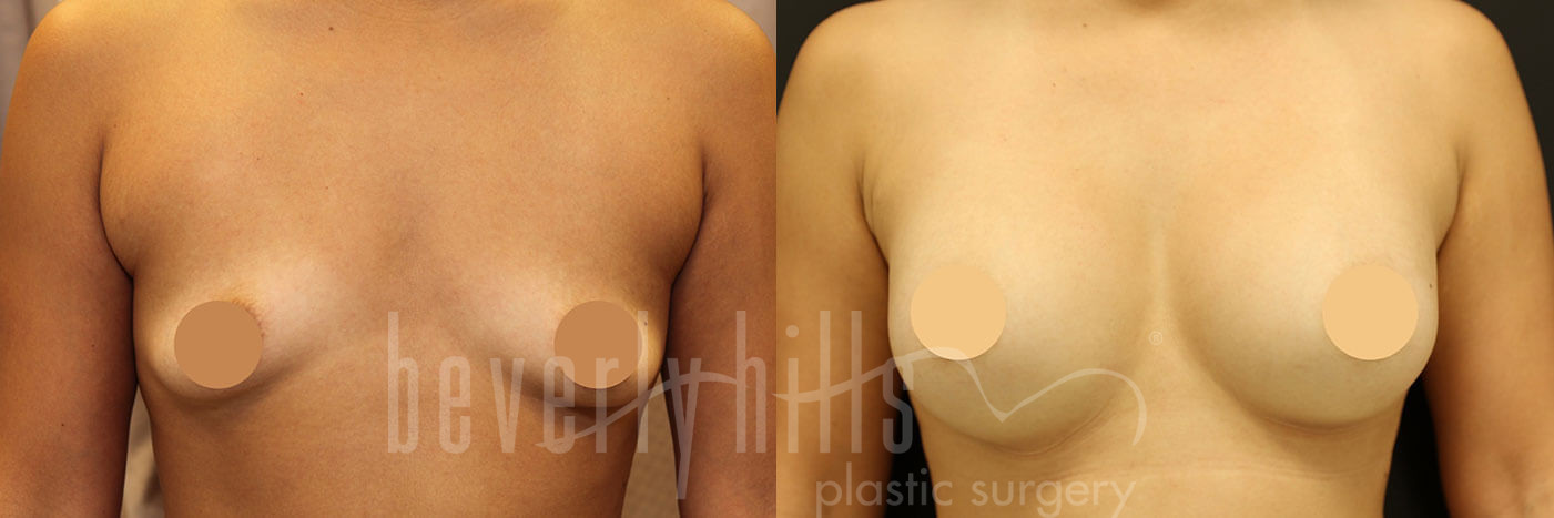 Breast Augmentation 72 Before & After